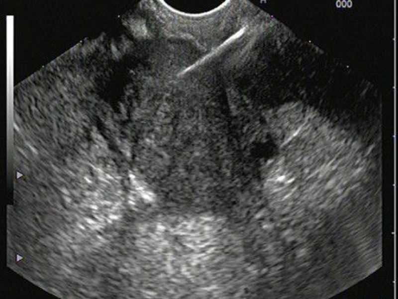 Ecoendoscopia