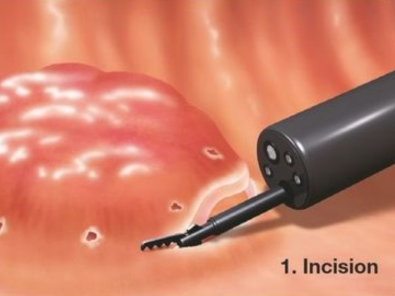 Dissecção Endoscópica de Submucosa